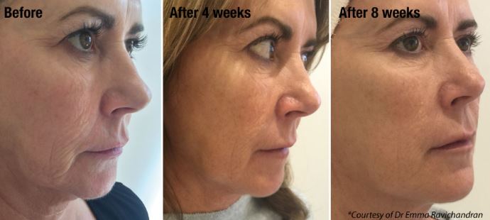 Anti Wrinkle Injections In Wirral