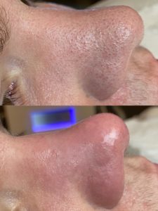 Blackhead Removal Wirral