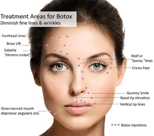 Botox 1 Botox 1