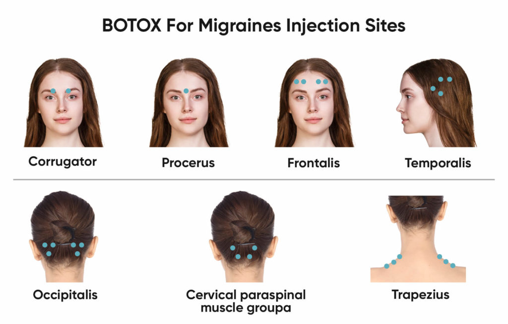 Botox For Migraines Botox For Migraines