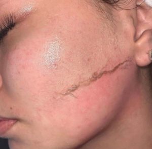 Dermaplaning Facial Hair Removal