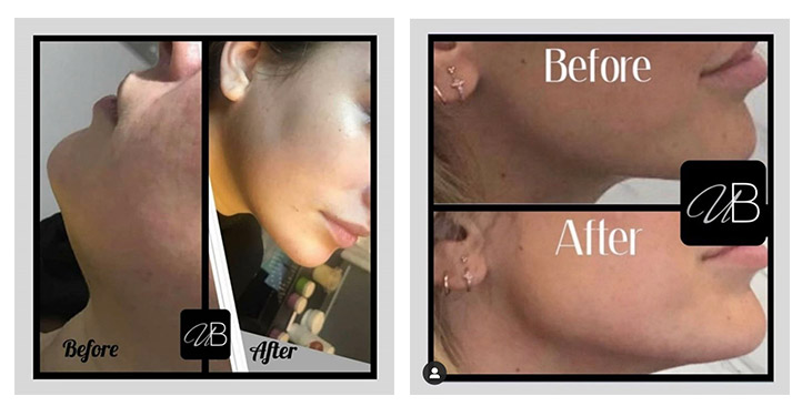 Jaw Contouring In Wirral