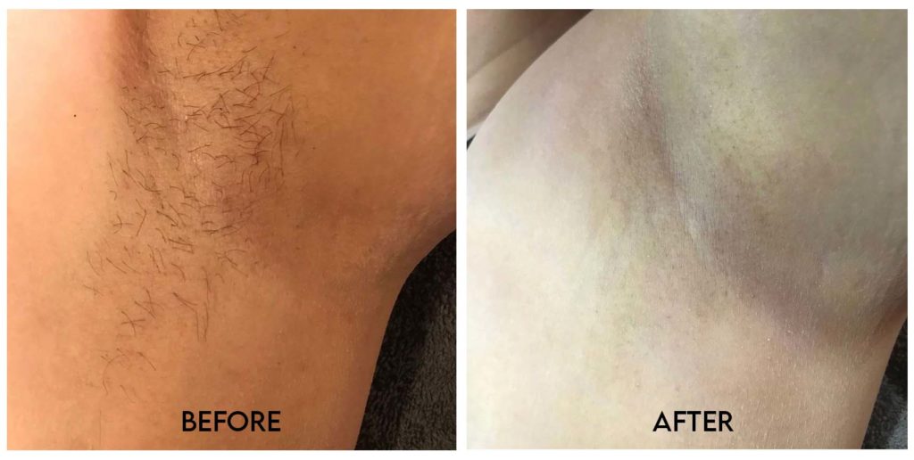 Laser Hair Removal Armpit Hair