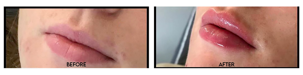 Lip Filler In Wirral Lip Filler In Wirral
