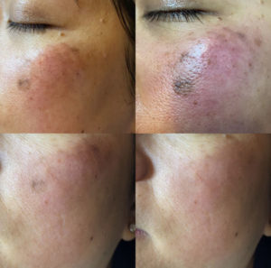 Pigmentation Resurfacing