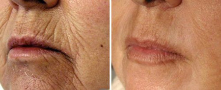 Smokers Lines Removal Smokers Lines Removal
