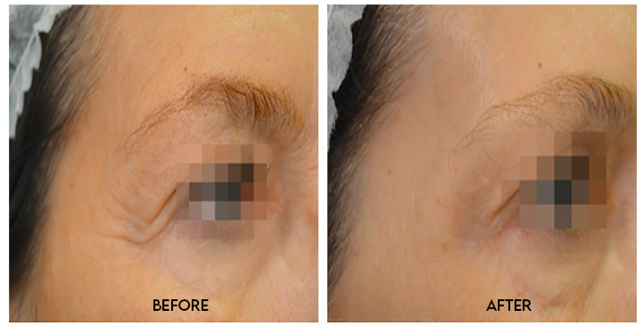 Viscoderm Hydrobooster Wirral Viscoderm Hydrobooster In Wirral